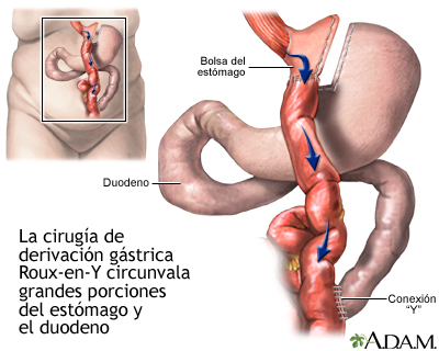 Cirugía gástrica en Y de Roux para perder peso