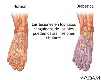 Circulación de la sangre diabética en el pie