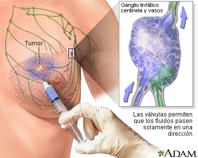 Biopsia de los ganglios centinelas