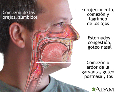 Síntomas de las alergias