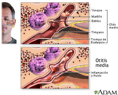 Infección del oído medio (otitis media)