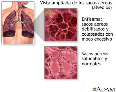 Enfermedad pulmonar obstructiva crónica (EPOC)