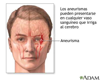 Aneurisma cerebral