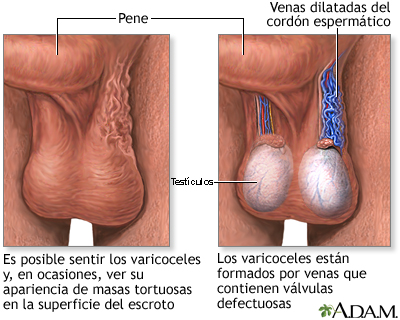 Varicocele