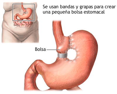 Gastroplastia vertical con banda