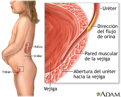 Reflujo vesicoureteral