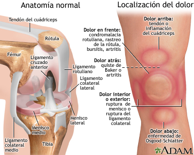 Dolor de rodilla