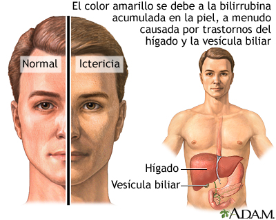 Ictericia