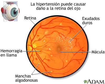 Retinopatía hipertensiva