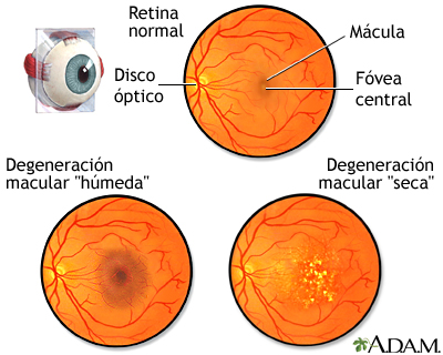 Degeneraci&#243;n macular