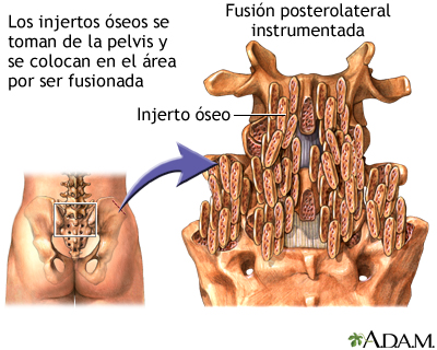 Procedimiento: fusión posterolateral instrumentada