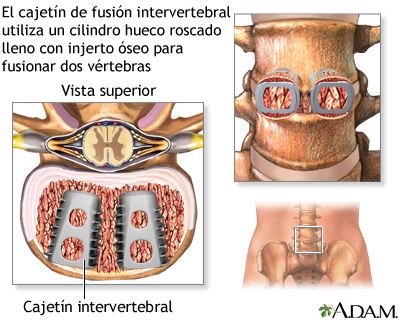 Cajetín de fusión intervertebral