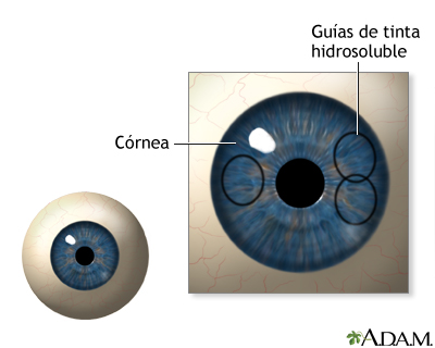 Procedimiento, parte 1