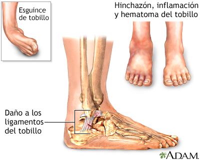 Esguince de tobillo