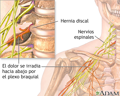 Dolor cervical