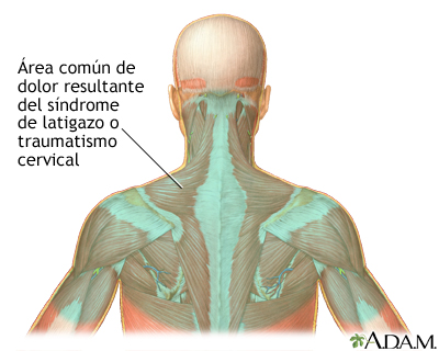 Localización del dolor por latigazo