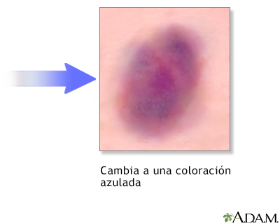 Cicatrización, parte 1