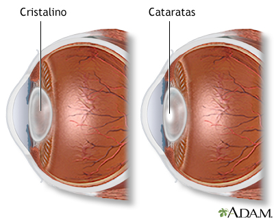 Catarata