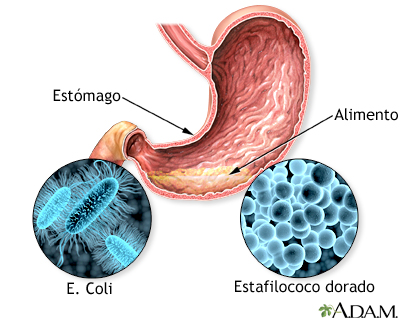 Intoxicación alimentaria