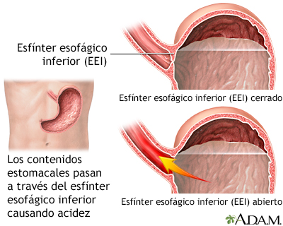 Enfermedad por reflujo gastroesofágico