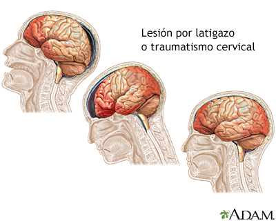 Trauma craneano