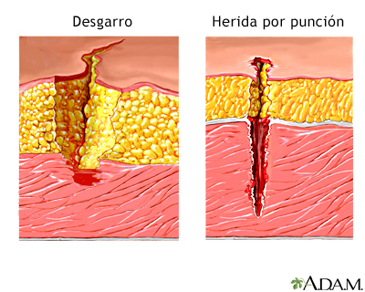 Desgarro versus herida penetrante