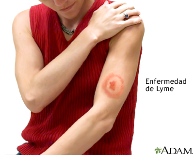 Enfermedad de Lyme