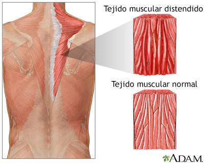 Distensión muscular