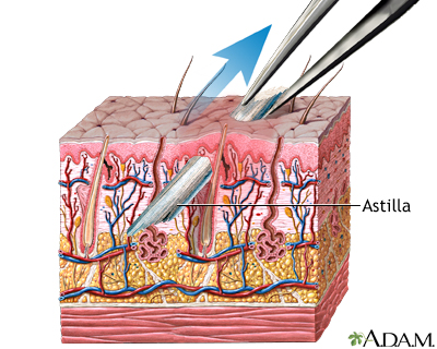 Extracción de una astilla