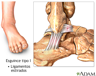 Esguince de tobillo tipo I