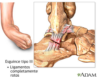 Esguince de tobillo tipo III