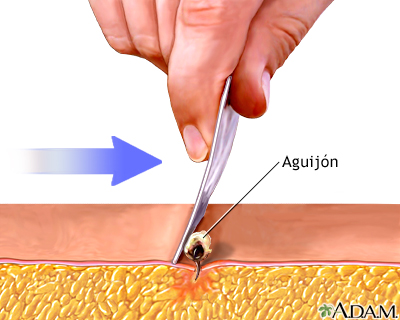 Extracción de un aguijón