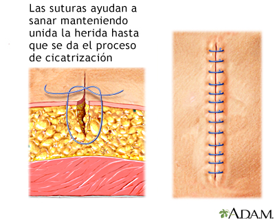 Suturas