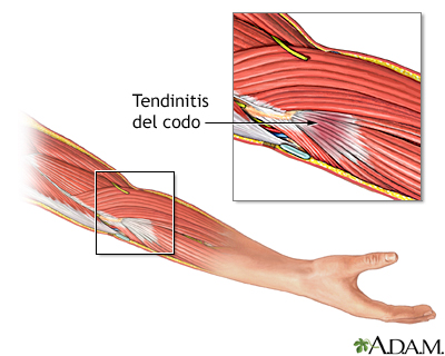 Tendinitis