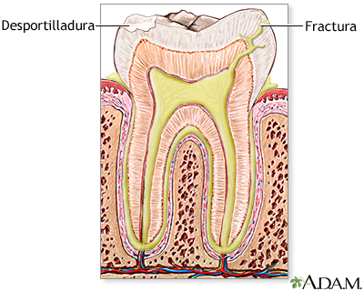 Diente fracturado