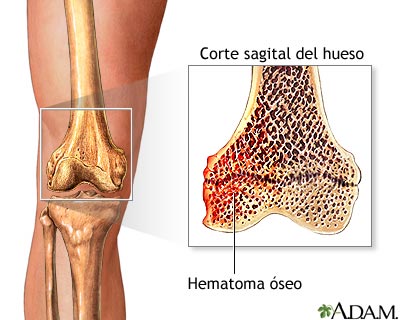 Hematoma óseo