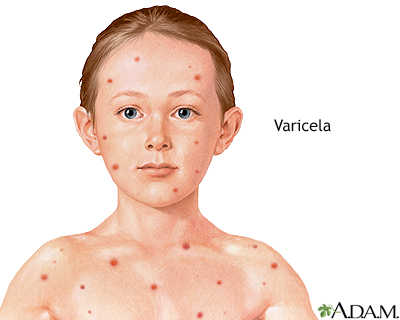 Varicela