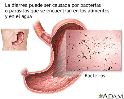 Diarrea