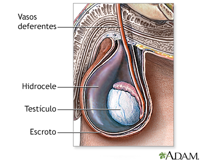 Hidrocele