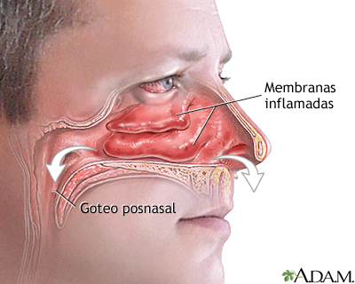 Goteo y congestión nasal