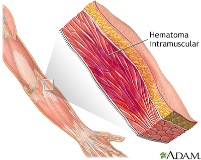 Hematoma muscular