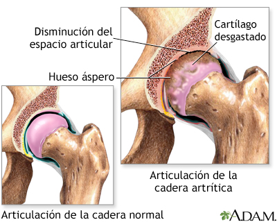 Artritis  en la cadera