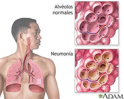 Neumonía