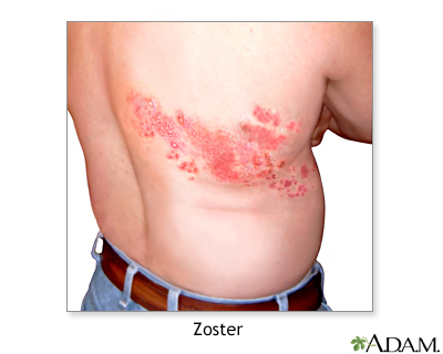 Herpes zoster