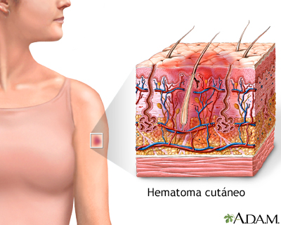 Hematoma de la piel