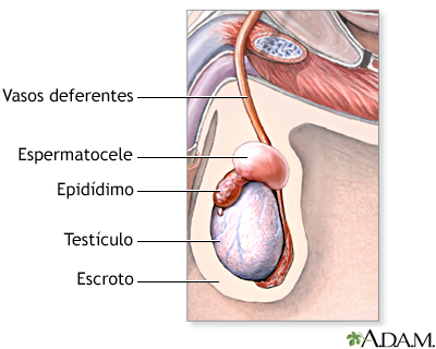 Espermatocele