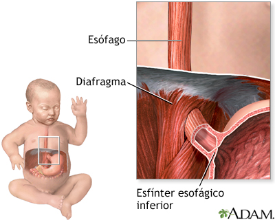 Regurgitación en los bebés