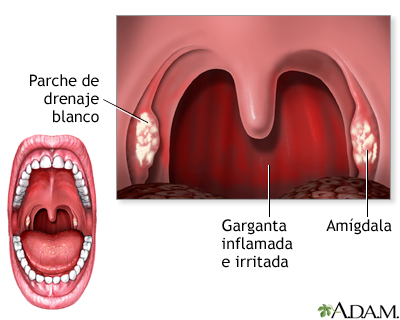 Faringitis estreptocócica