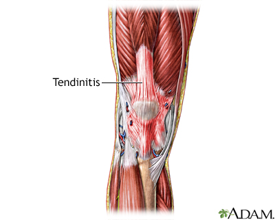 Tendinitis