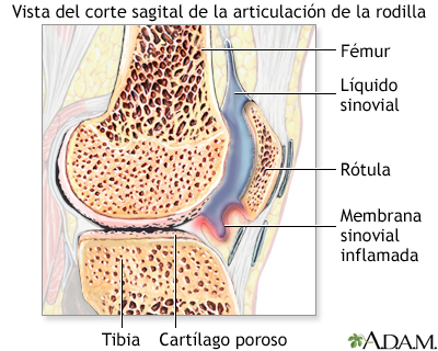 Artritis reumatoidea